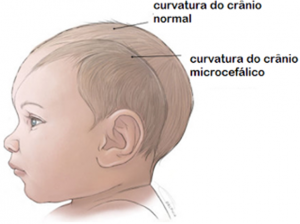 microcefalia